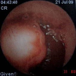 1.- CARCINOIDE DE ILEON