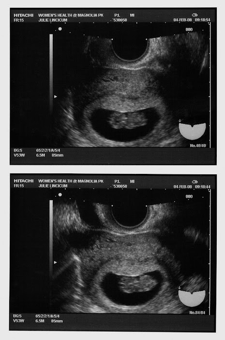 9 Week Ultrasound