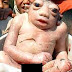Bebê Anencéfalo nasceu parecido com um sapo no Nepal