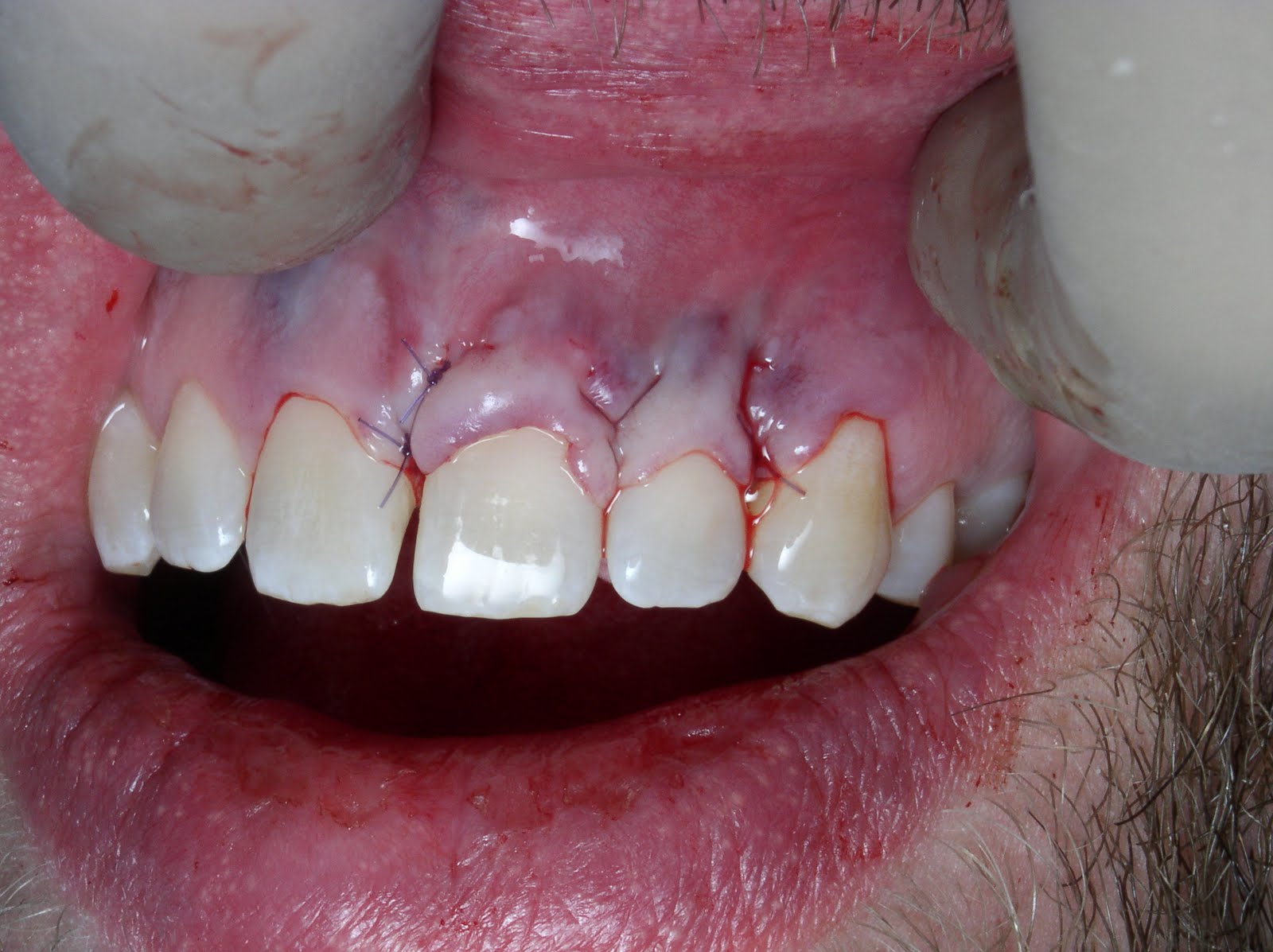 Periodontal Implant Cases by Dr. Thomas Kang Connective Tissue Grafts