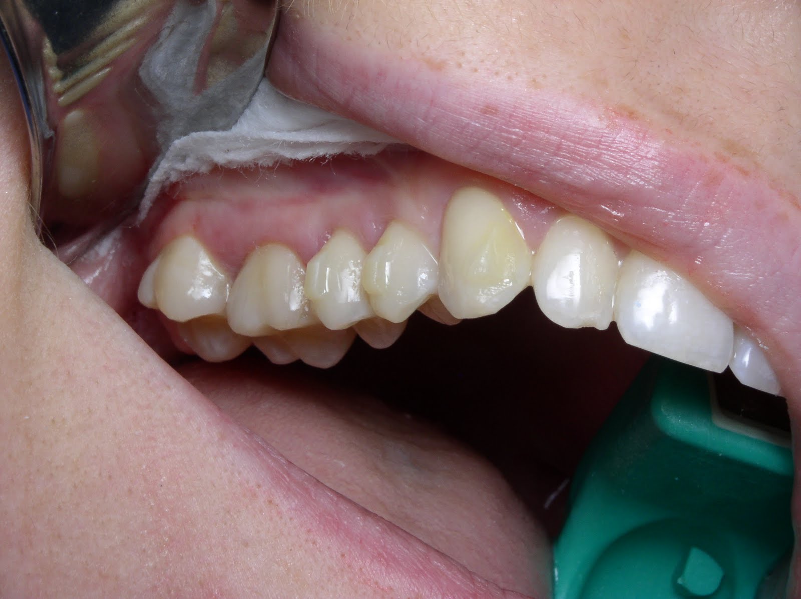 Periodontal Implant Cases by Dr. Thomas Kang PAOO Wilcko