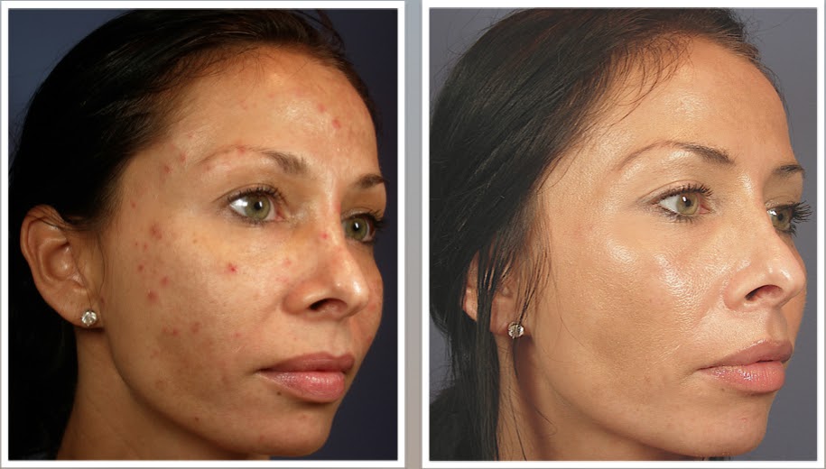 Chino Valley Cosmetic Surgery & Med Spa: Vi Peel, Get the Glow with