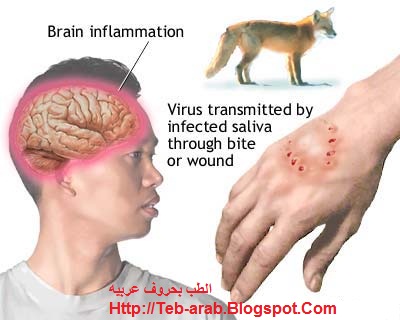 الإسعافات الأولية لعضة الحيوان - الطب والصحة Rabies.+%D8%A7%D9%84%D8%B3%D8%B9%D8%A7%D8%B1