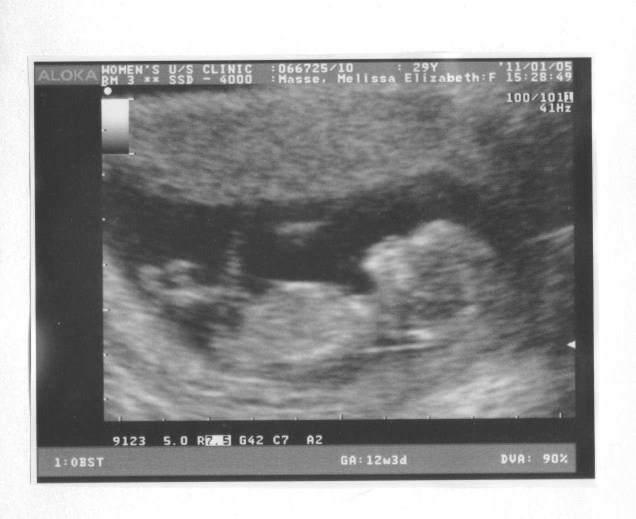 Ultrasound Week 12