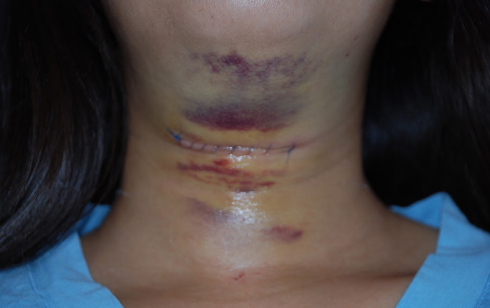 Mi Familia Linda Thyroglossal Duct Cyst, Sistrunk