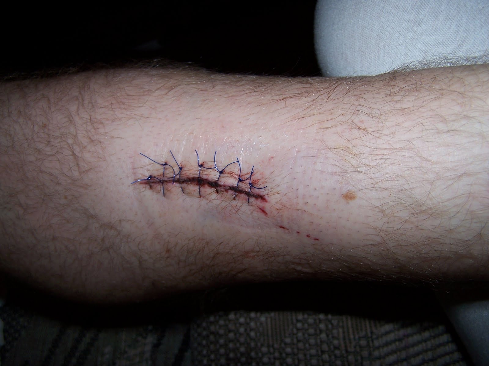 Stitches Images