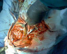 Operasi Fraktur Patella