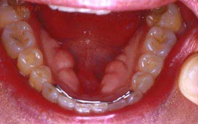 Dental Torus