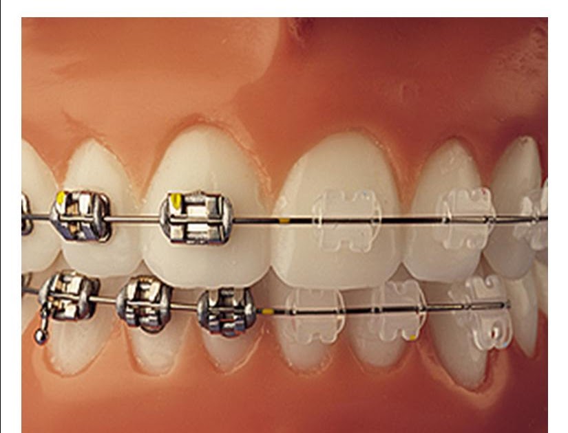 Orthodontist Melbourne Launceston Dentist The Cost of Braces