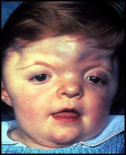 Enfermedad De Canavan