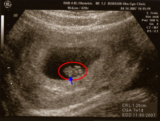 ultrasound scan at 5 weeks.