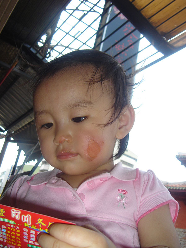 Burn Lip