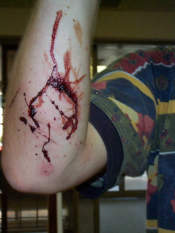 Cut Of Arm