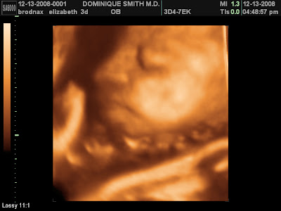 3D ultrasound of Pippa 3d ultrasound photos. 3D ultrasound of Pippa