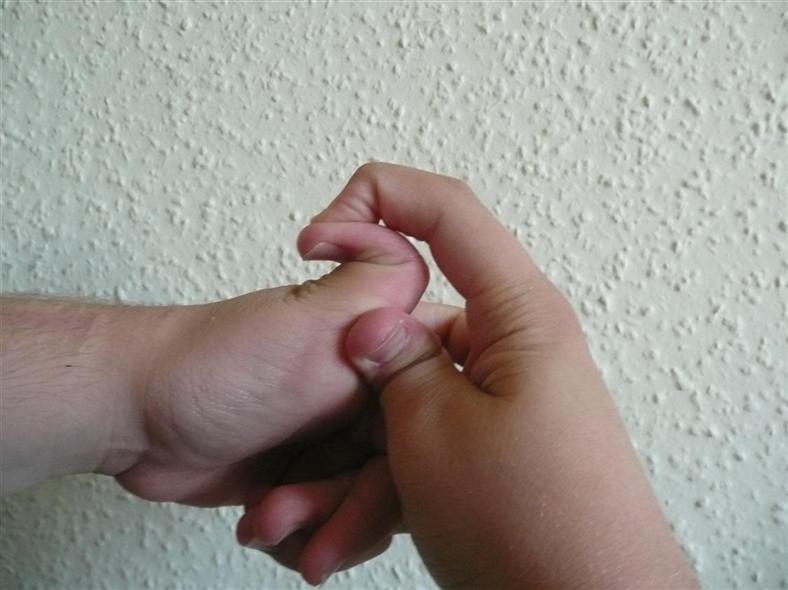 [Ehlers-Danlos_thumb.jpg]