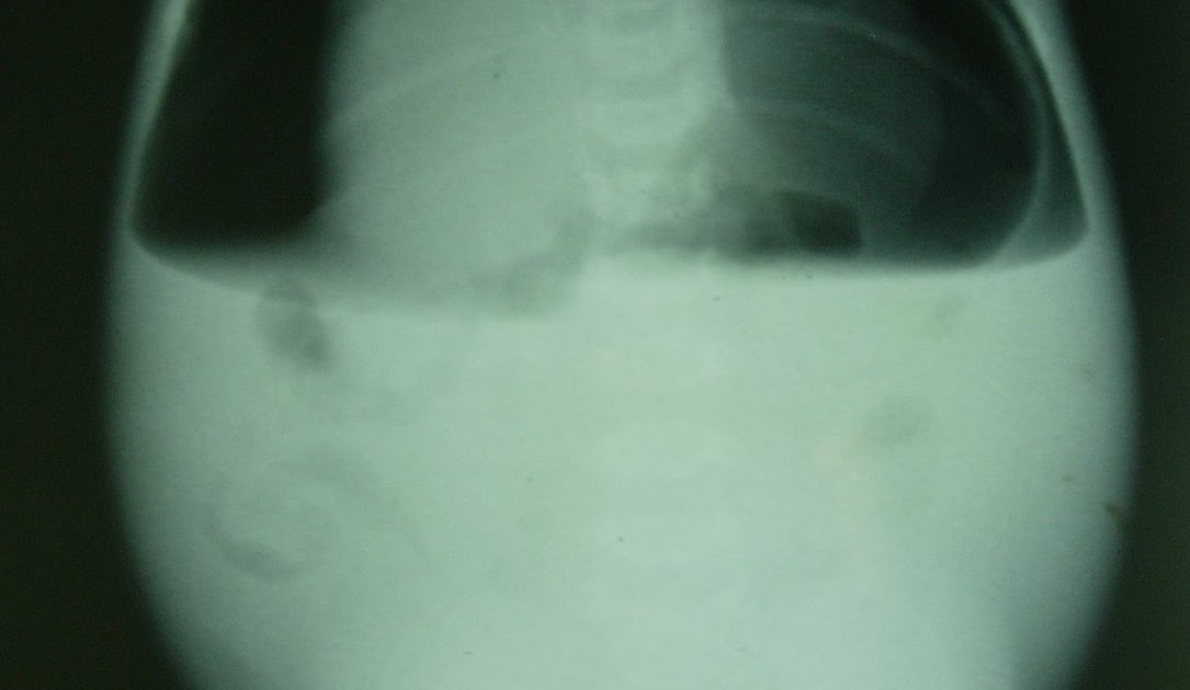 Perforation Peritonitis Because Of Meconium Ileus