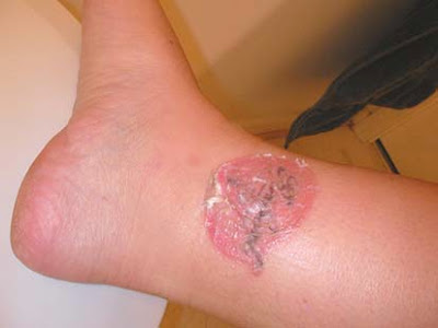 Tattoo Removal After Picture 1 Dermabrasion Tattoo RemovalFeel Free from