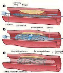 How Stents Function