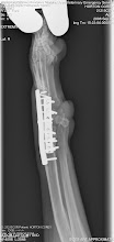 Corey's X-ray