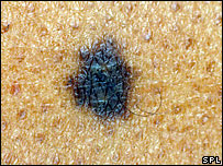 [melanoma_mole.JPG]