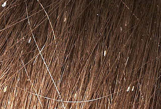 http://1.bp.blogspot.com/_QjIFU6rd0O8/S7xi3eXZWNI/AAAAAAAAAGA/hZoJ1e6rOIM/s1600/dermnet_rf_photo_of_lice_in_hair.jpg