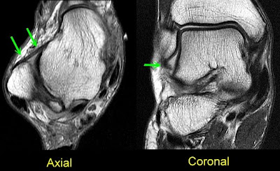 Mri Ankle Ligaments