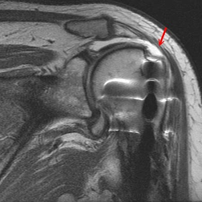 the shoulder MRI is able