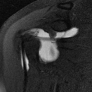 Arthrogram Mri