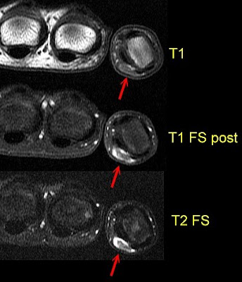 Mri Of Thumb