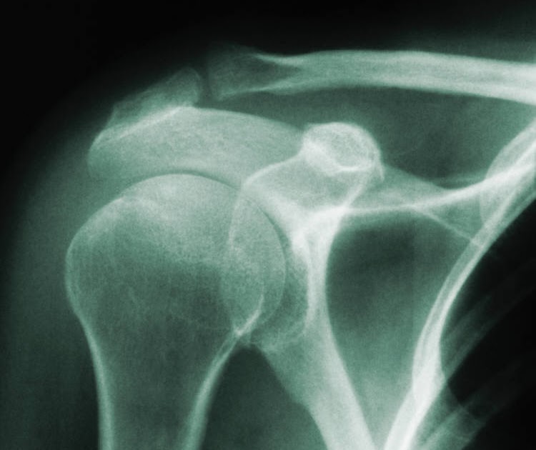 Physiotherapy Fitness Beauty How is a frozen shoulder diagnosed?