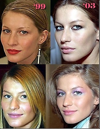Before And After Plastic Surgery Photos. Celebrities - Before And After