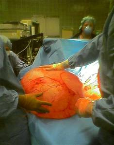 Ovary Cyst Size