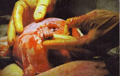 [Unborn_baby_grabs_surgeon.jpg]