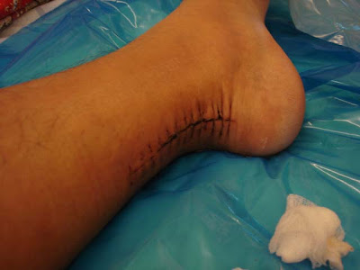 The stitches...looks like