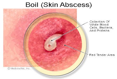 Did You Know That Did You Know Their Is A Easy Way To Remove A Boil