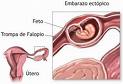 Embrión desarrollandose en la trompa uterina