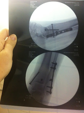 After surgery xrays