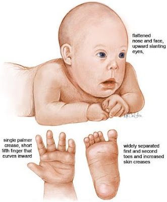 external image down-syndrome.jpg