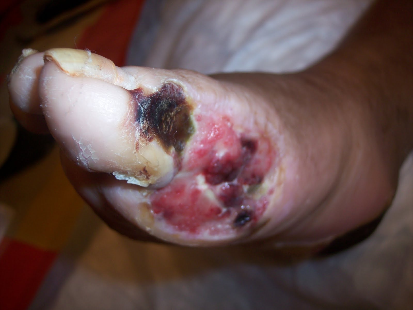 Necrotic Foot