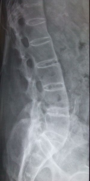 [spine+x-ray.jpg]