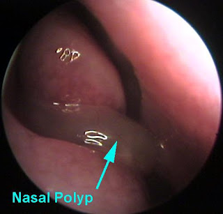 nasal polip