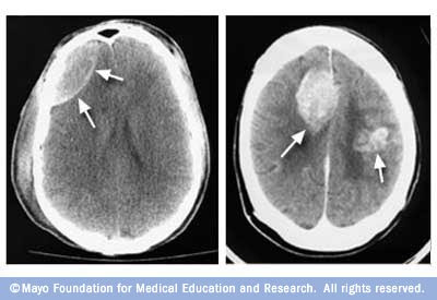 Ct+scan+brain+bleed