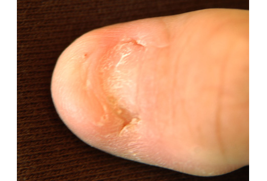 Nail-patella syndrome is an autosomal dominant condition characterized by