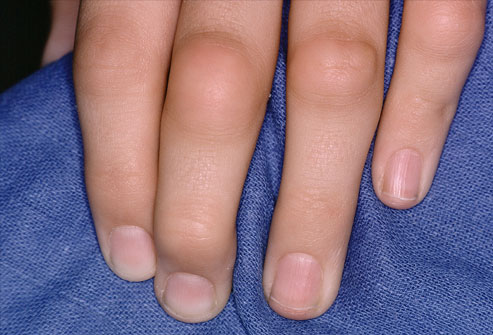 Rheumatoid Arthritis Fingers Who Gets Rheumatoid Arthritis ?