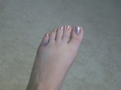 The Russo Corner: This is what a broken toe looks like...