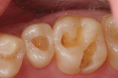 multiple caries