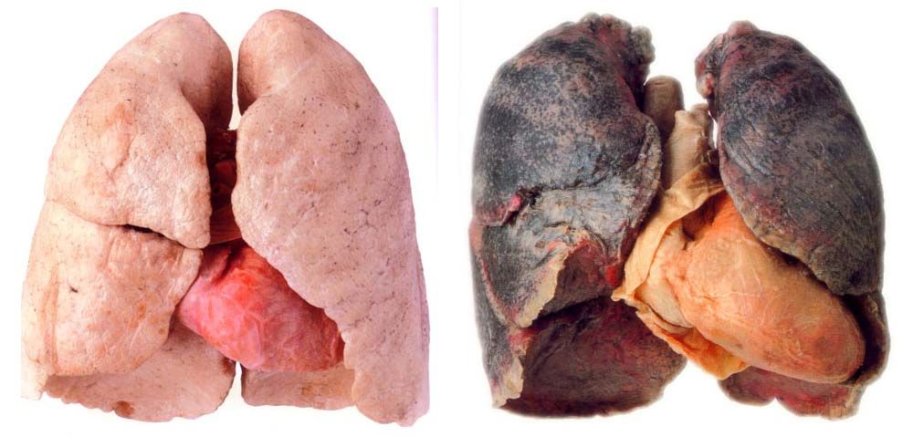before and after smoking lungs