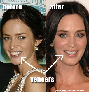 Emily Blunt Plastic Surgery Before and After
