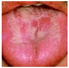 candidiasis mucosa