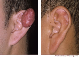 Keloid before and after steroid injection